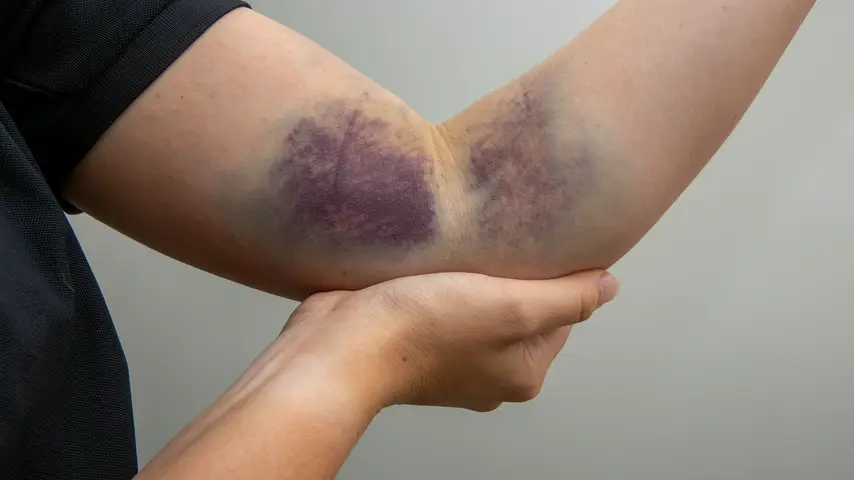 Contusions